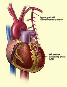 Heart showing mammary artery graft